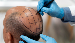 Hair Transplant