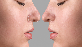 Rhinoplasty